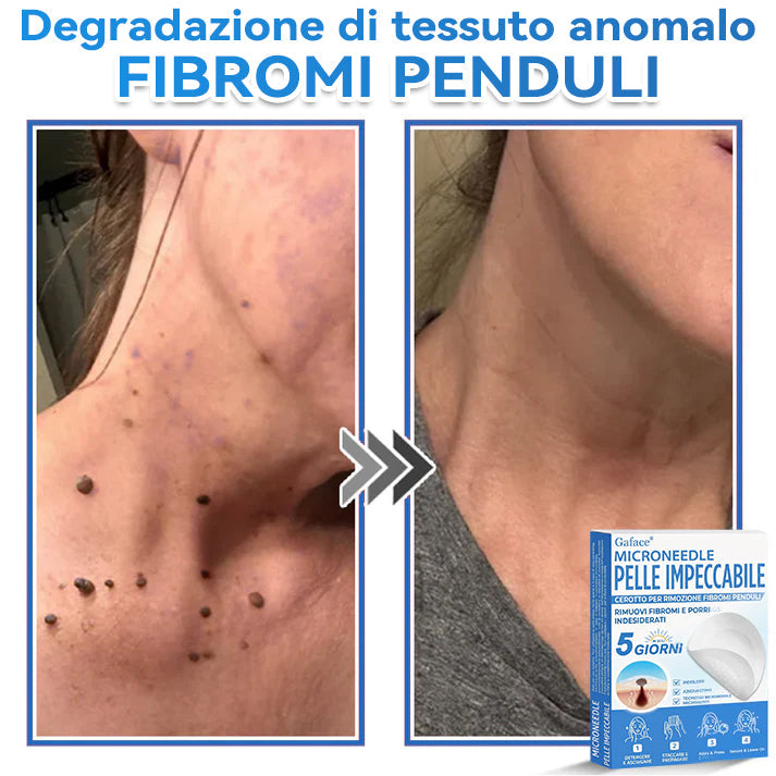 🩹 𝐆𝐚𝐟𝐚𝐜𝐞® 𝐌𝐢𝐜𝐫𝐨𝐧𝐞𝐞𝐝𝐥𝐞 𝐏𝐞𝐥𝐥𝐞 𝐈𝐦𝐩𝐞𝐜𝐜𝐚𝐛𝐢𝐥𝐞 𝐂𝐞𝐫𝐨𝐭𝐭𝐨 𝐏𝐞𝐫 𝐑𝐢𝐦𝐨𝐳𝐢𝐨𝐧𝐞 𝐅𝐢𝐛𝐫𝐨𝐦𝐢 𝐏𝐞𝐧𝐝𝐮𝐥𝐢 | Trattamento per nei in rilievo, acne, verruche piane e fibromi penduli | Attenua rughe, cicatrici e imperfezioni | Cerotti invisibili per brufoli (viso e corpo)🌌🌌