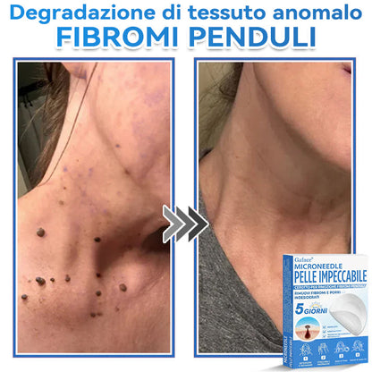 🩹 𝐆𝐚𝐟𝐚𝐜𝐞® 𝐌𝐢𝐜𝐫𝐨𝐧𝐞𝐞𝐝𝐥𝐞 𝐏𝐞𝐥𝐥𝐞 𝐈𝐦𝐩𝐞𝐜𝐜𝐚𝐛𝐢𝐥𝐞 𝐂𝐞𝐫𝐨𝐭𝐭𝐨 𝐏𝐞𝐫 𝐑𝐢𝐦𝐨𝐳𝐢𝐨𝐧𝐞 𝐅𝐢𝐛𝐫𝐨𝐦𝐢 𝐏𝐞𝐧𝐝𝐮𝐥𝐢 | Trattamento per nei in rilievo, acne, verruche piane e fibromi penduli | Attenua rughe, cicatrici e imperfezioni | Cerotti invisibili per brufoli (viso e corpo)🌌🌌