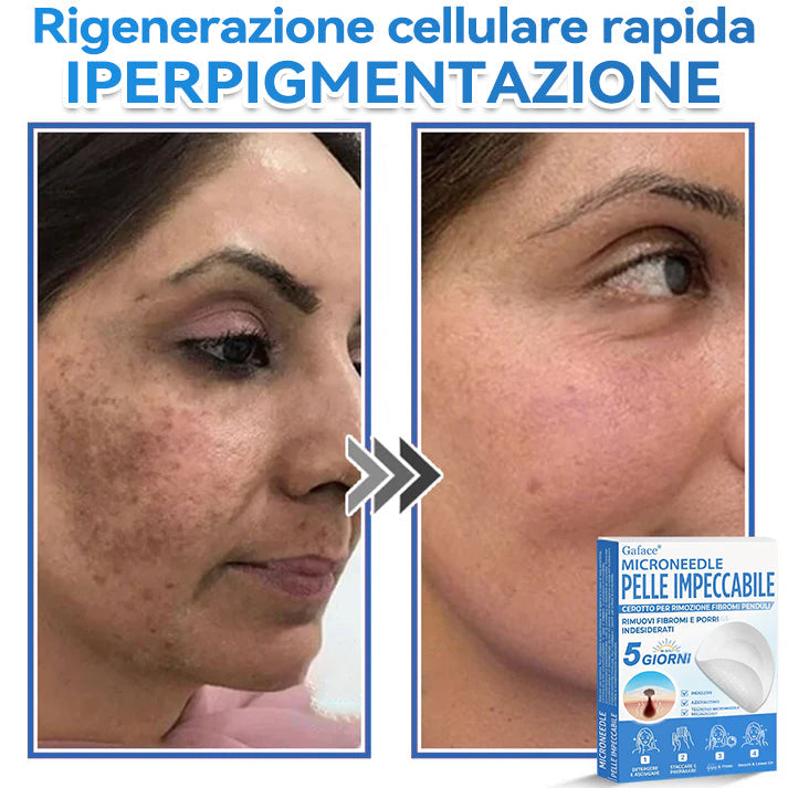 🩹 𝐆𝐚𝐟𝐚𝐜𝐞® 𝐌𝐢𝐜𝐫𝐨𝐧𝐞𝐞𝐝𝐥𝐞 𝐏𝐞𝐥𝐥𝐞 𝐈𝐦𝐩𝐞𝐜𝐜𝐚𝐛𝐢𝐥𝐞 𝐂𝐞𝐫𝐨𝐭𝐭𝐨 𝐏𝐞𝐫 𝐑𝐢𝐦𝐨𝐳𝐢𝐨𝐧𝐞 𝐅𝐢𝐛𝐫𝐨𝐦𝐢 𝐏𝐞𝐧𝐝𝐮𝐥𝐢 | Trattamento per nei in rilievo, acne, verruche piane e fibromi penduli | Attenua rughe, cicatrici e imperfezioni | Cerotti invisibili per brufoli (viso e corpo)🌌🌌